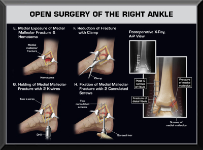 Ankle ORIF Surgery Medical Trail Exhibit