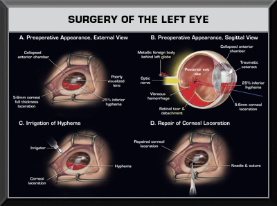 Eye Surgery Medical Trail Exhibit