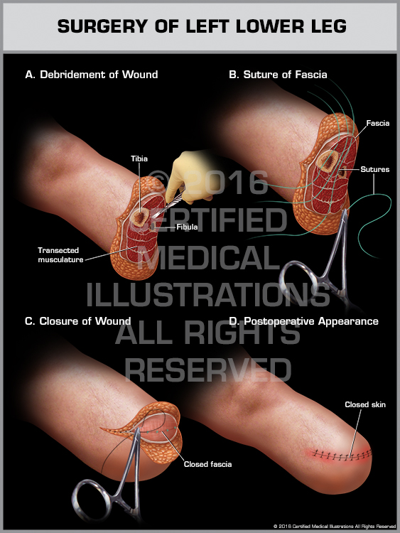 Below Knee Amputation medical trial exhibit