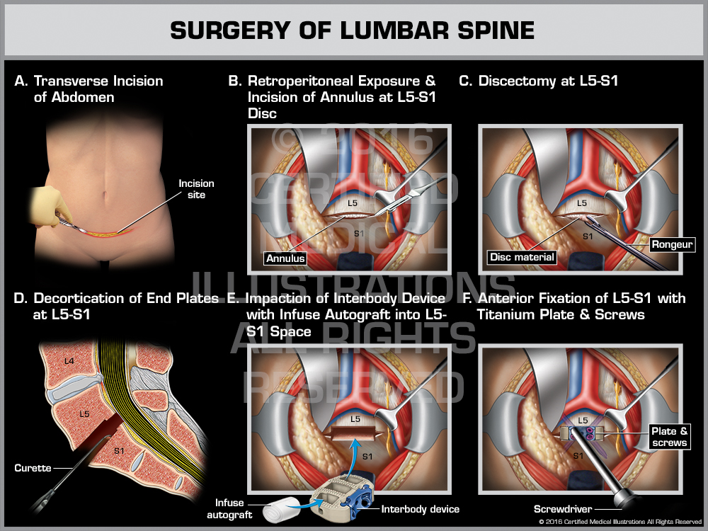 Anterior Lumbar Fusion Medical Trial Exhibit