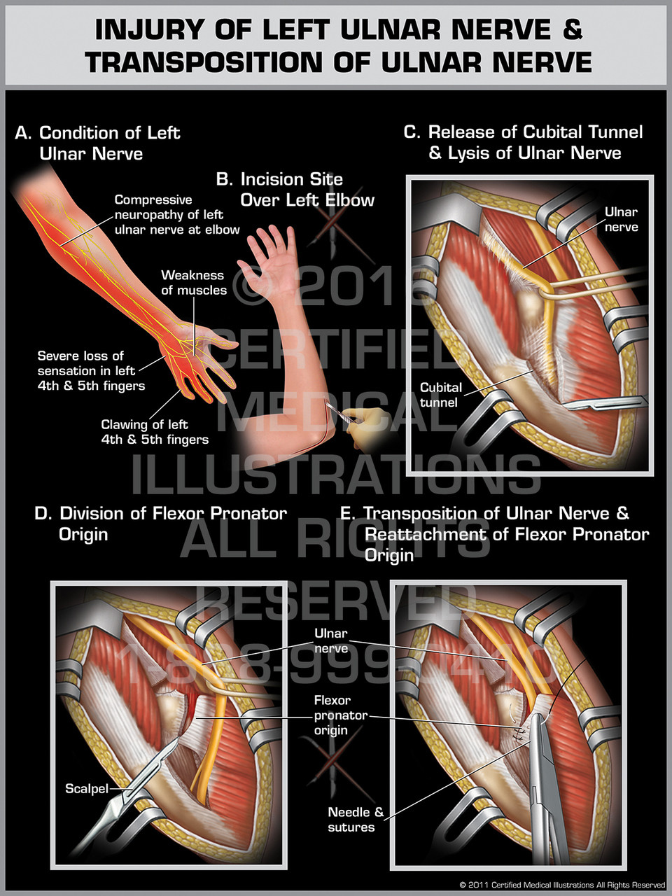 Ulnar Nerve Transposition