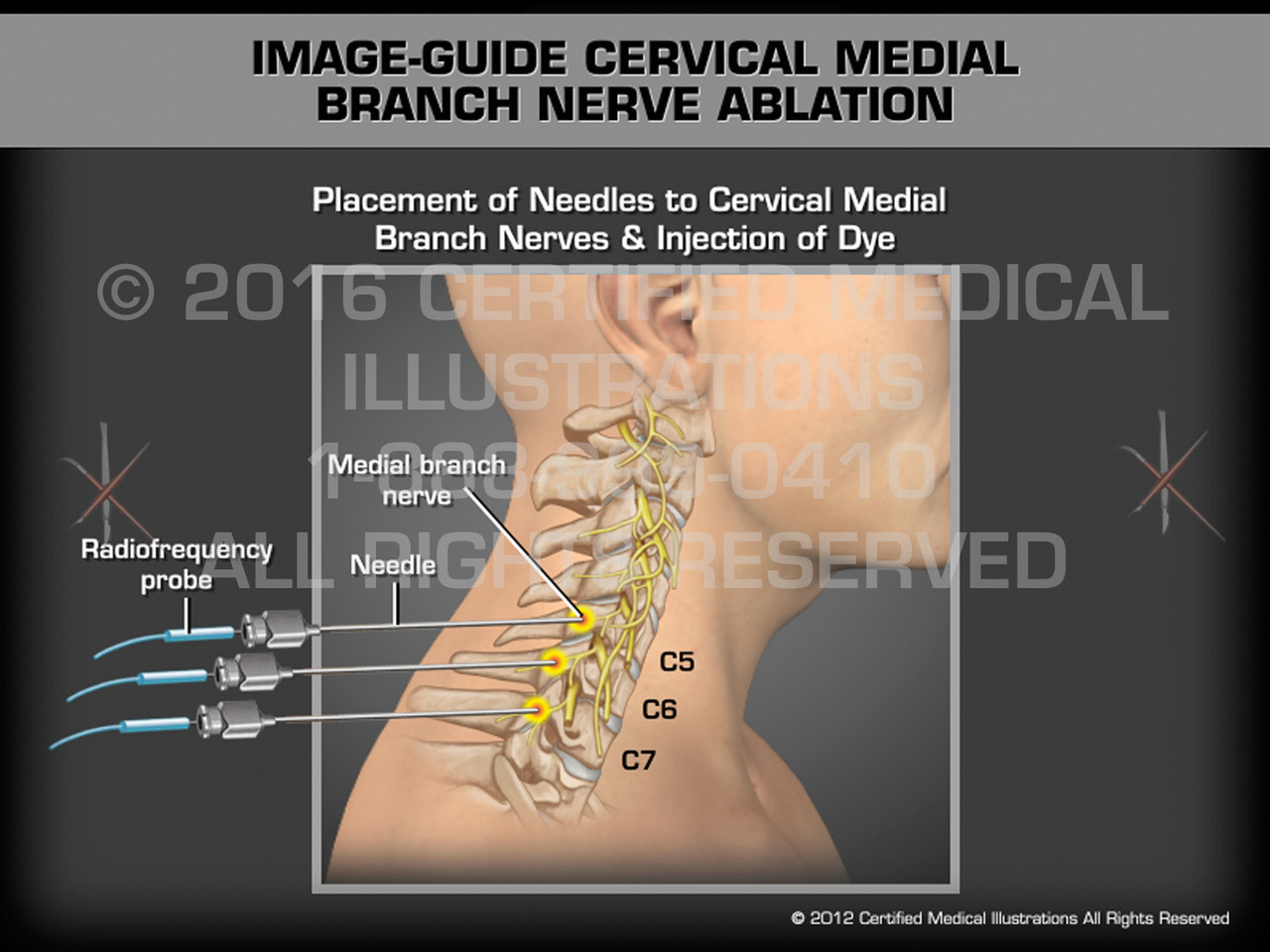 Image-Guide Cervical Medial Branch Nerve Ablation - Medical Animation