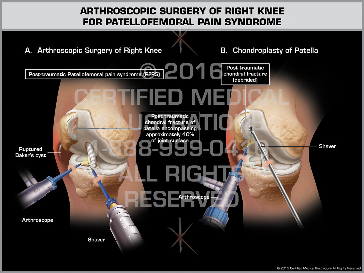 Arthroscopic Surgery of Right Knee for Patellofemoral Pain