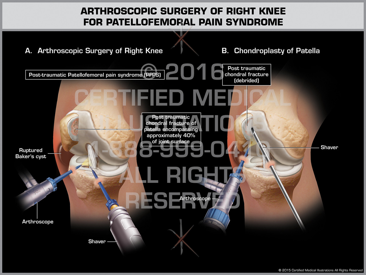 arthroscopic surgery of right knee for patellofemoral patella femoral syndrome