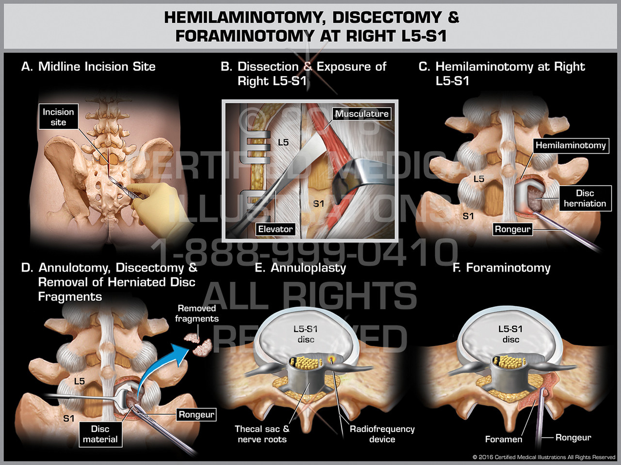 lumbar foraminotomy