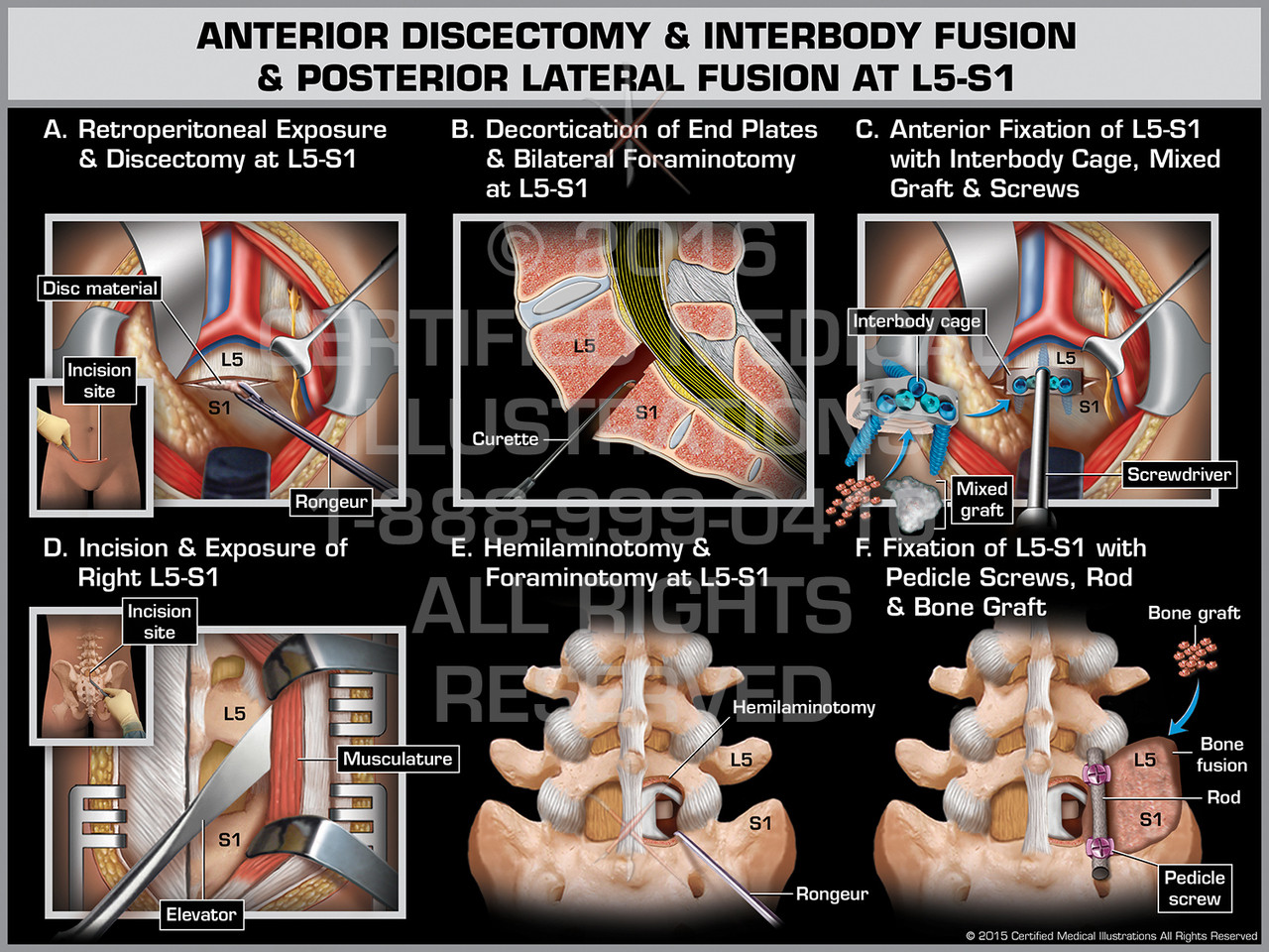 Anterior Discectomy & Interbody Fusion & Posterior Lateral