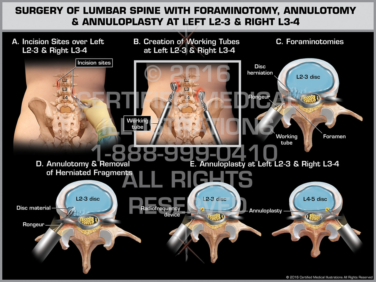 lumbar foraminotomy