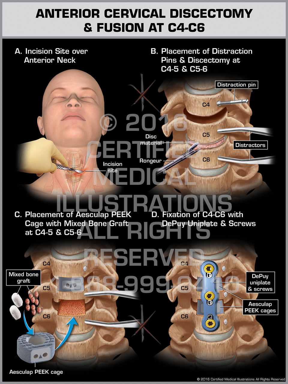 Anterior Cervical Discectomy & Fusion at C4-C6