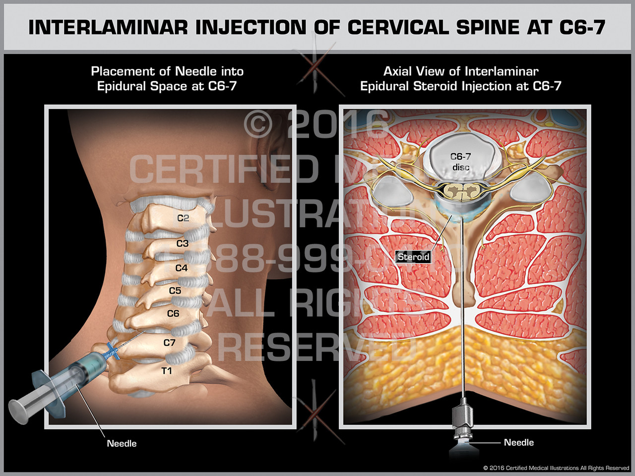 Interlaminar Injection of Cervical Spine at C6-7 - Print Quality
