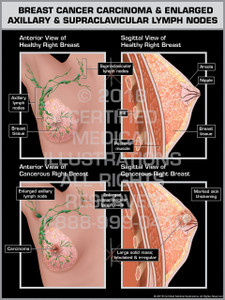 Location of Right Metastatic Breast Cancer & Enlarged Axillary