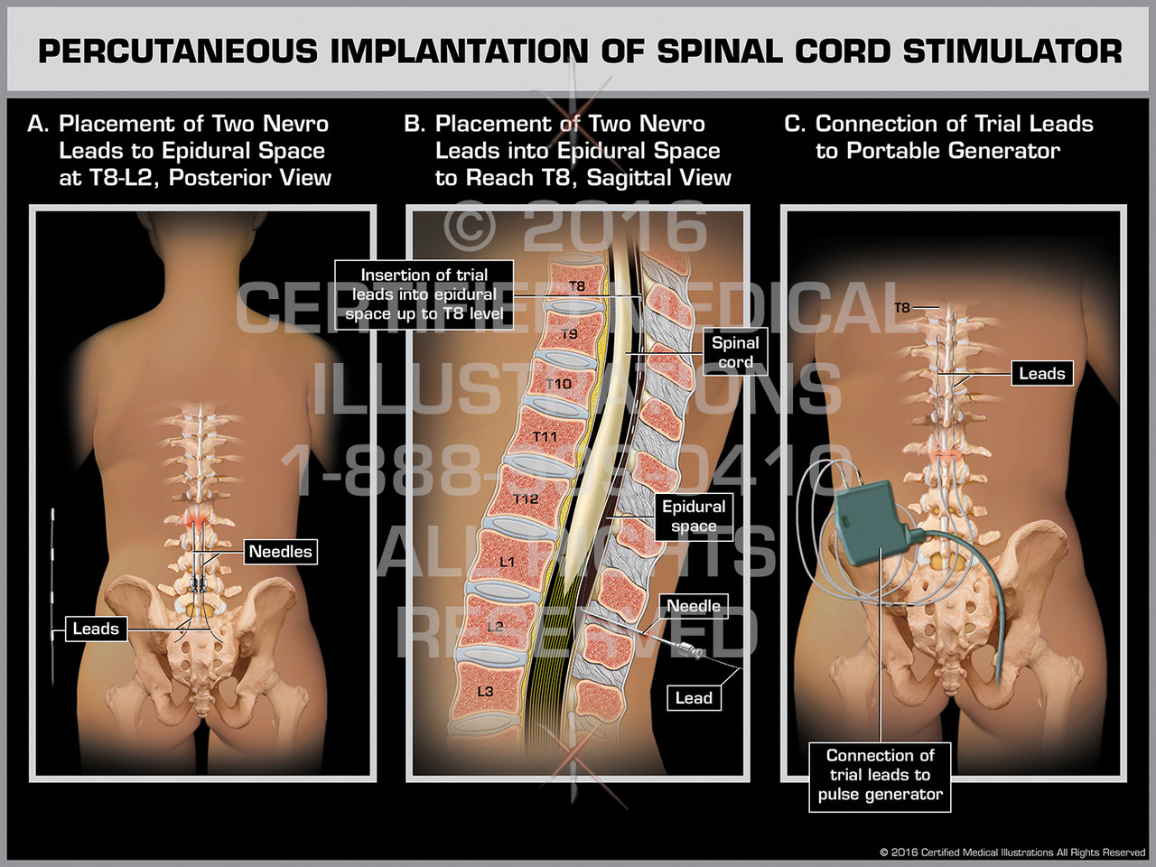 Percutaneous Implantation of Spinal Cord Stimulator - Print Quality
