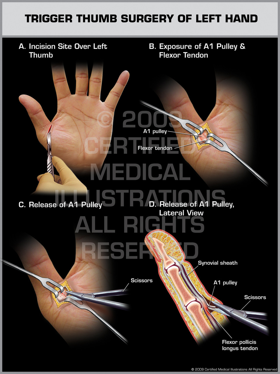 Trigger Thumb Surgery of Left Hand