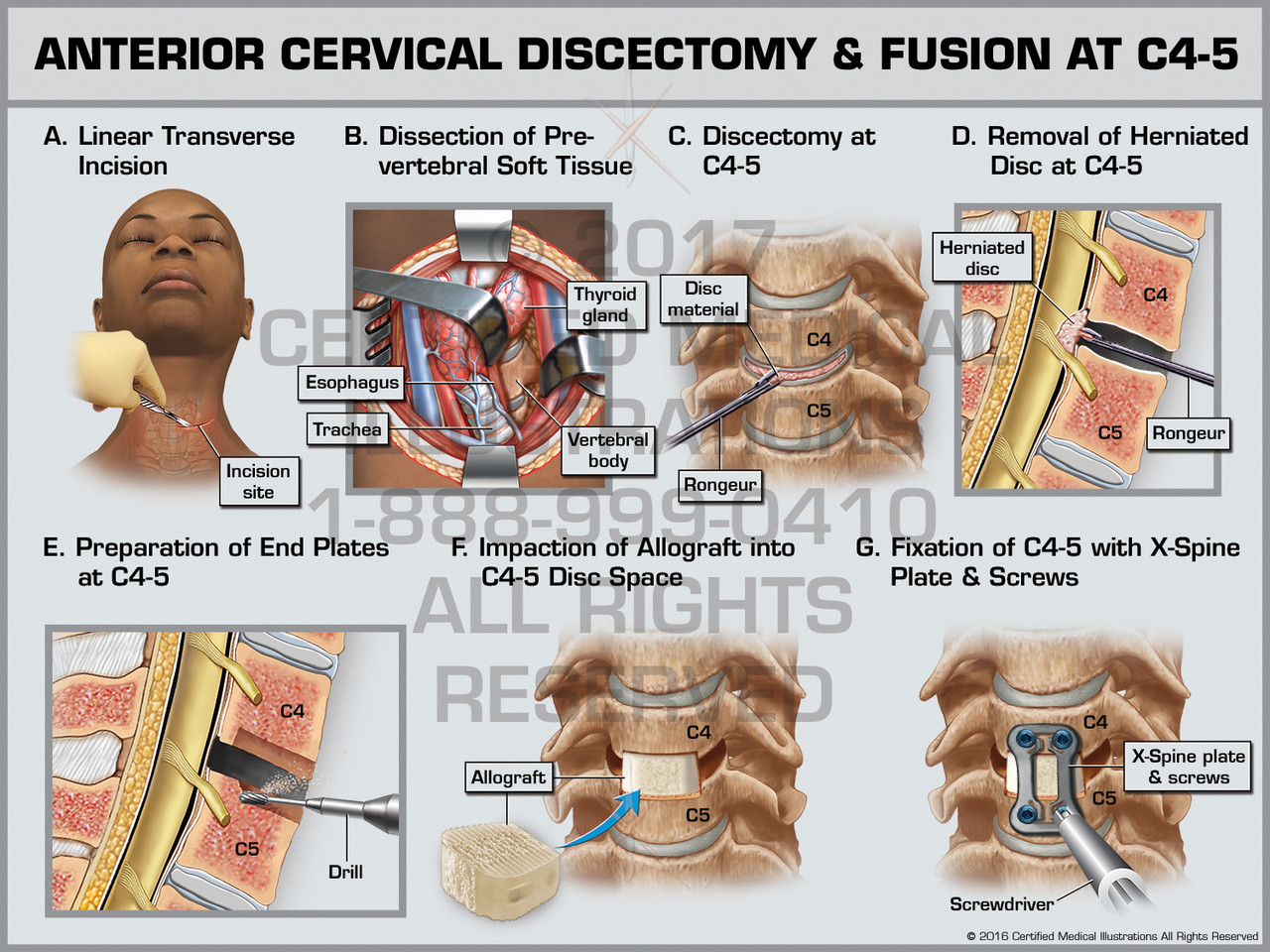 Anterior Cervical Discectomy & Fusion at C45