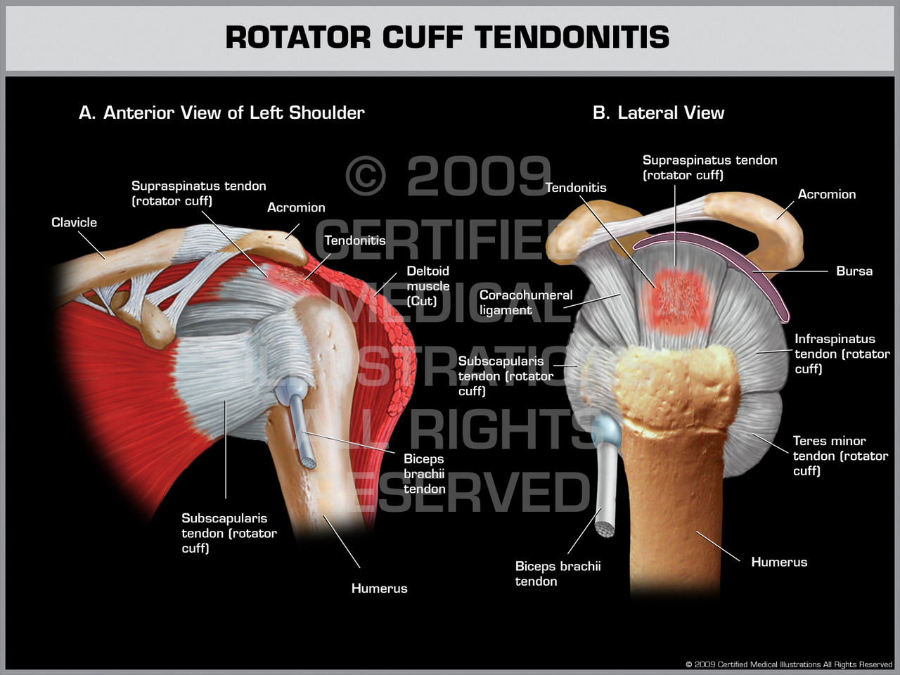 rotator tendonitis