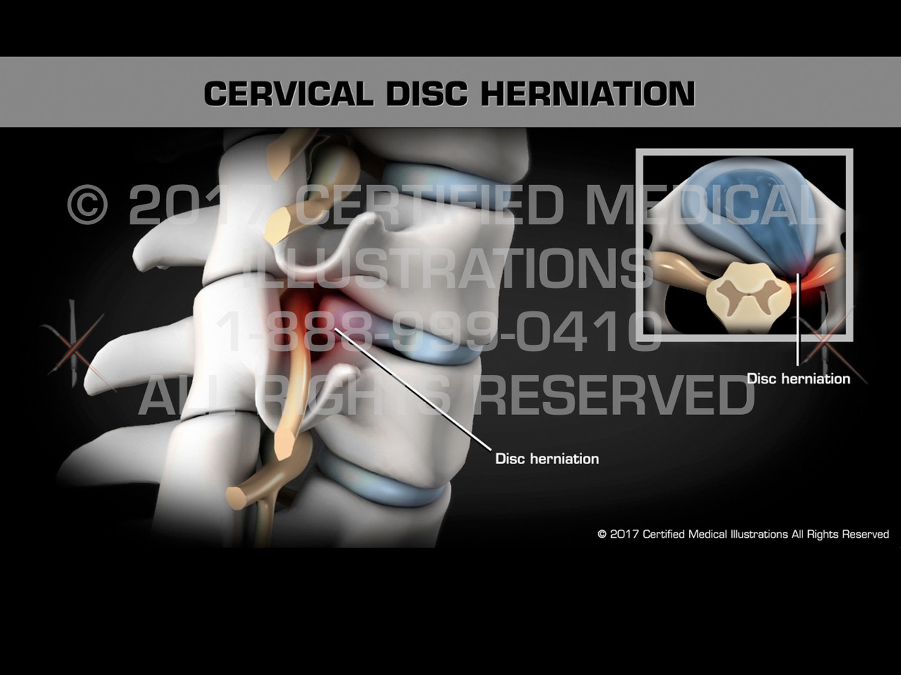 Cervical Disc Herniation Medical Animation