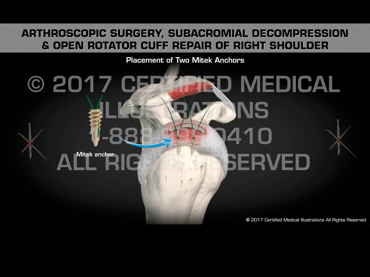 Shoulder arthroscopy subacromial rotator cuff repair