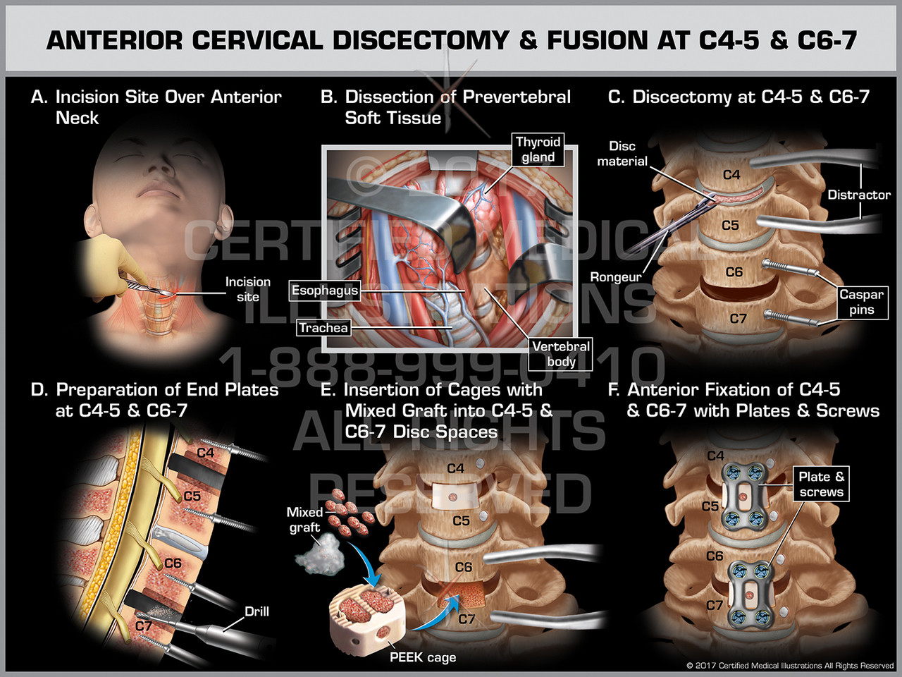 Anterior Cervical Discectomy & Fusion at C45 & C67