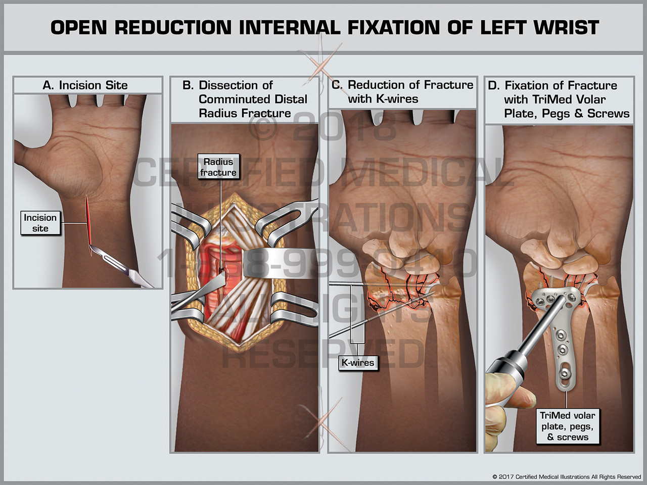Evaluation Of Open Reduction And Internal Fixation