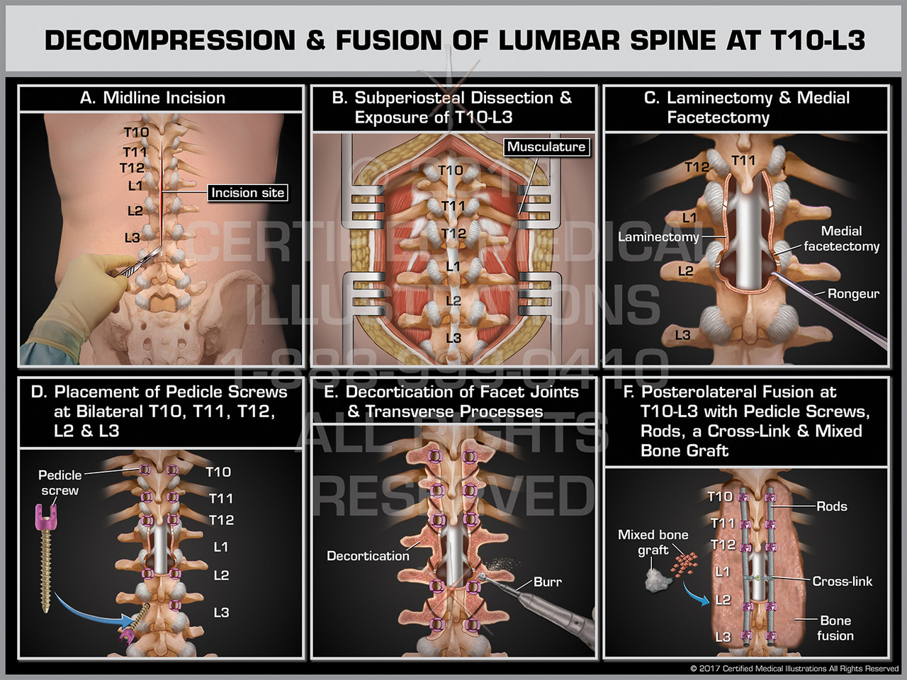 Decompression Fusion Of Lumbar Spine At T10 L3 Decompression Fusion Of Lumbar Spine At T10 L3