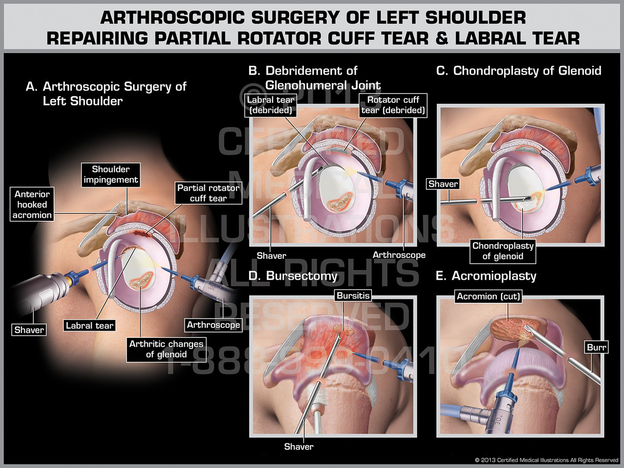 Arthroscopic Surgery of Left Shoulder Repairing Partial