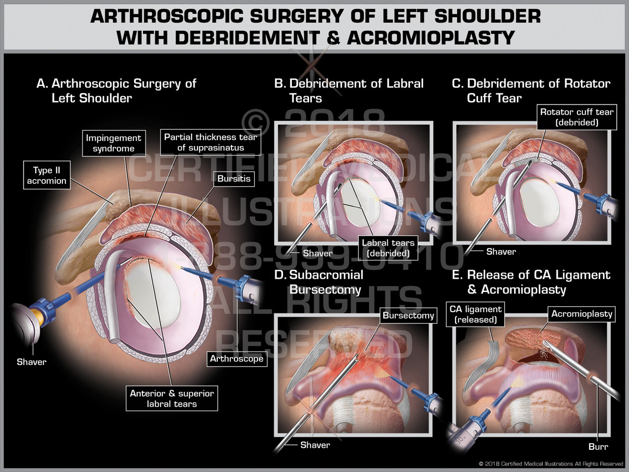 Arthroscopic Surgery of Left Shoulder with Debridement