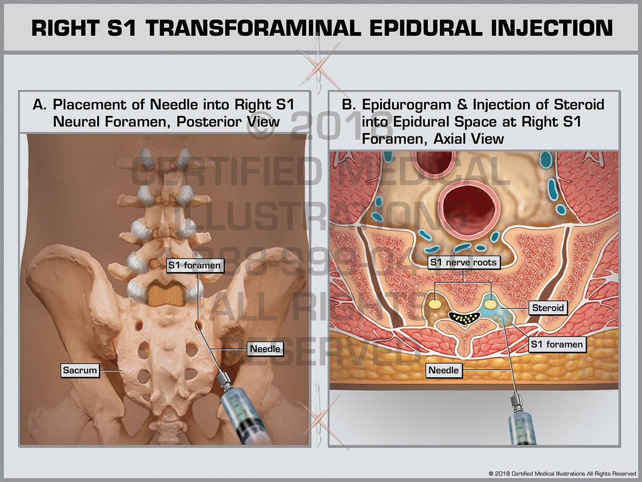 transforaminal steroid injections transforaminal steroid injections