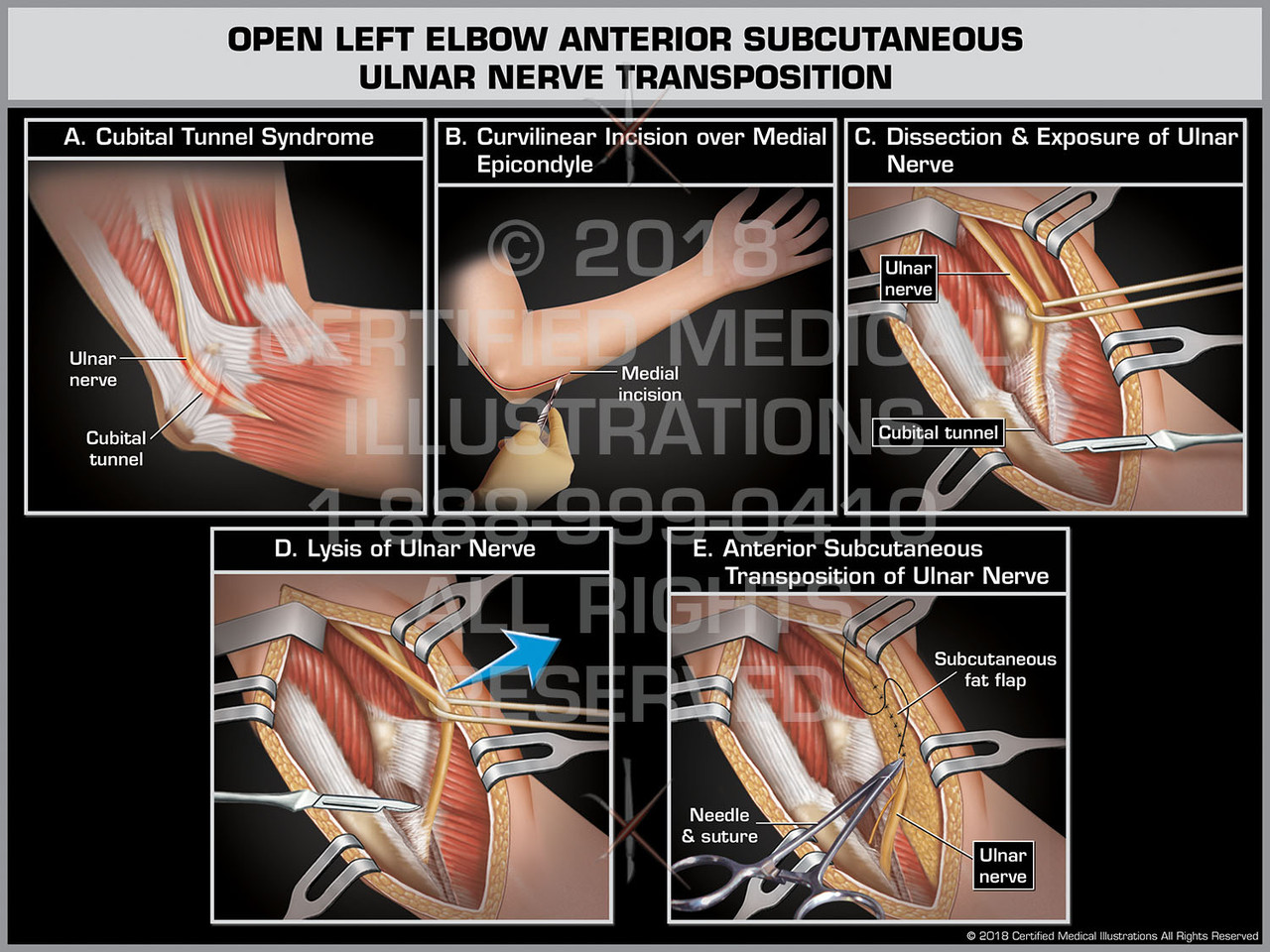 Open Left Elbow Anterior Subcutaneous Ulnar Nerve