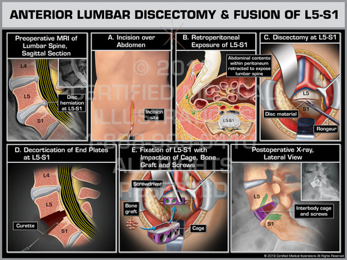 Anterior Lumbar Discectomy and Fusion of L5S1 Print