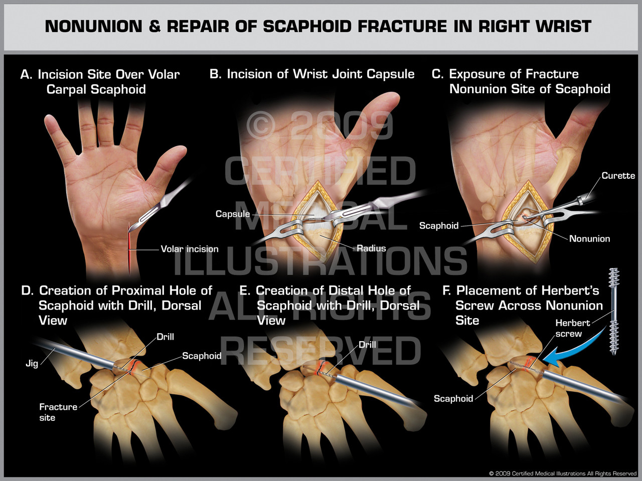 [Surgery for Pseudarthrosis of the Scaphoid Bone Performed in Hungary ], A scaphoid pseudarthrosis