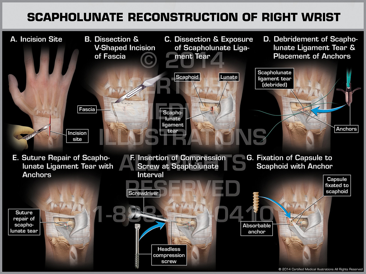 Scapholunate Reconstruction of Right Wrist Scapholunate Reconstruction of Right Wrist