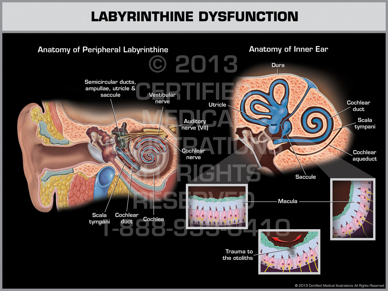 Labyrinthine Dysfunction