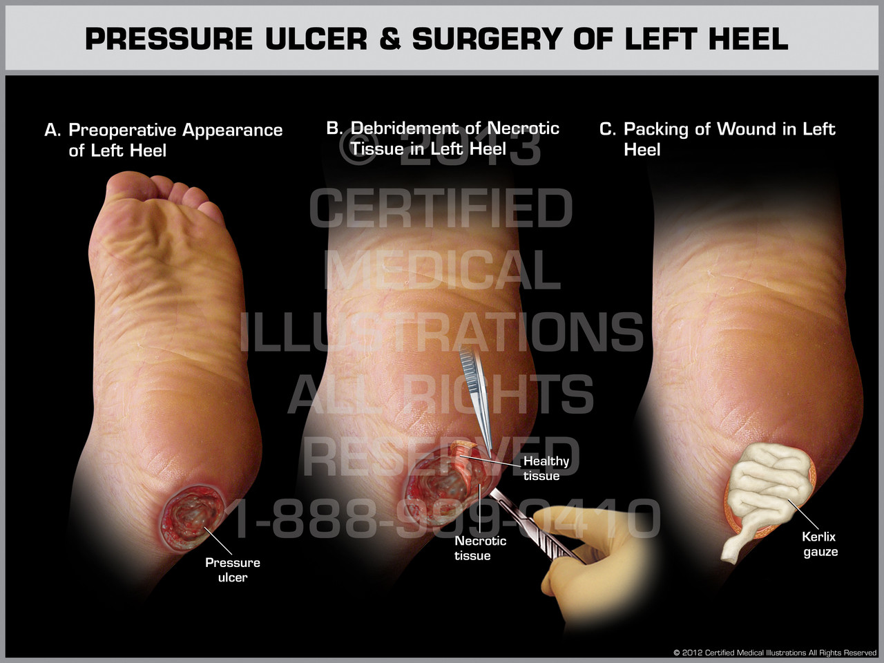 ulcer