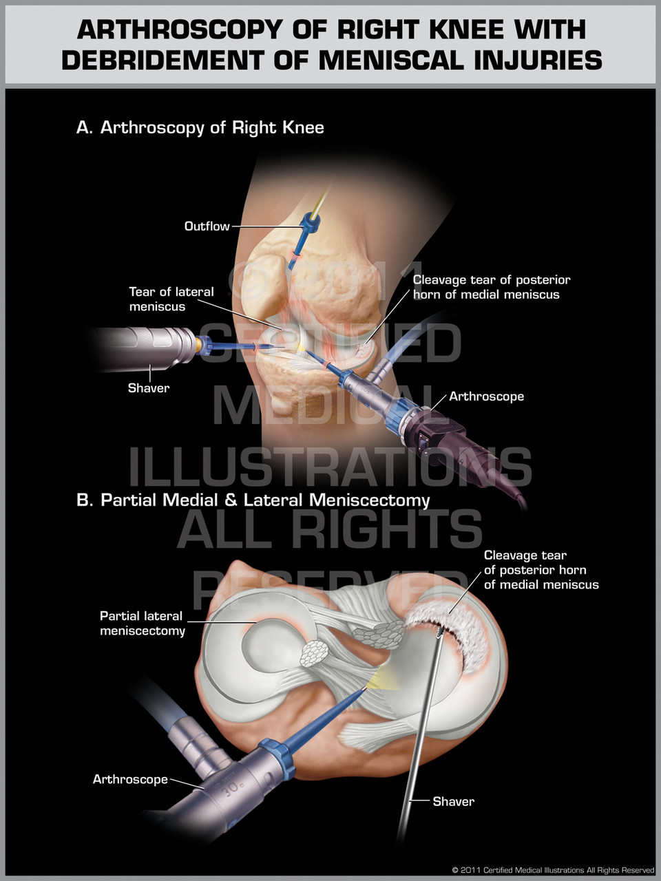 Arthroscopy of Right Knee with Debridement of Meniscal Injuries