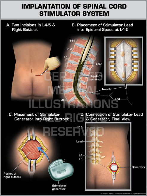 implanted spinal stimulator implanted spinal stimulator