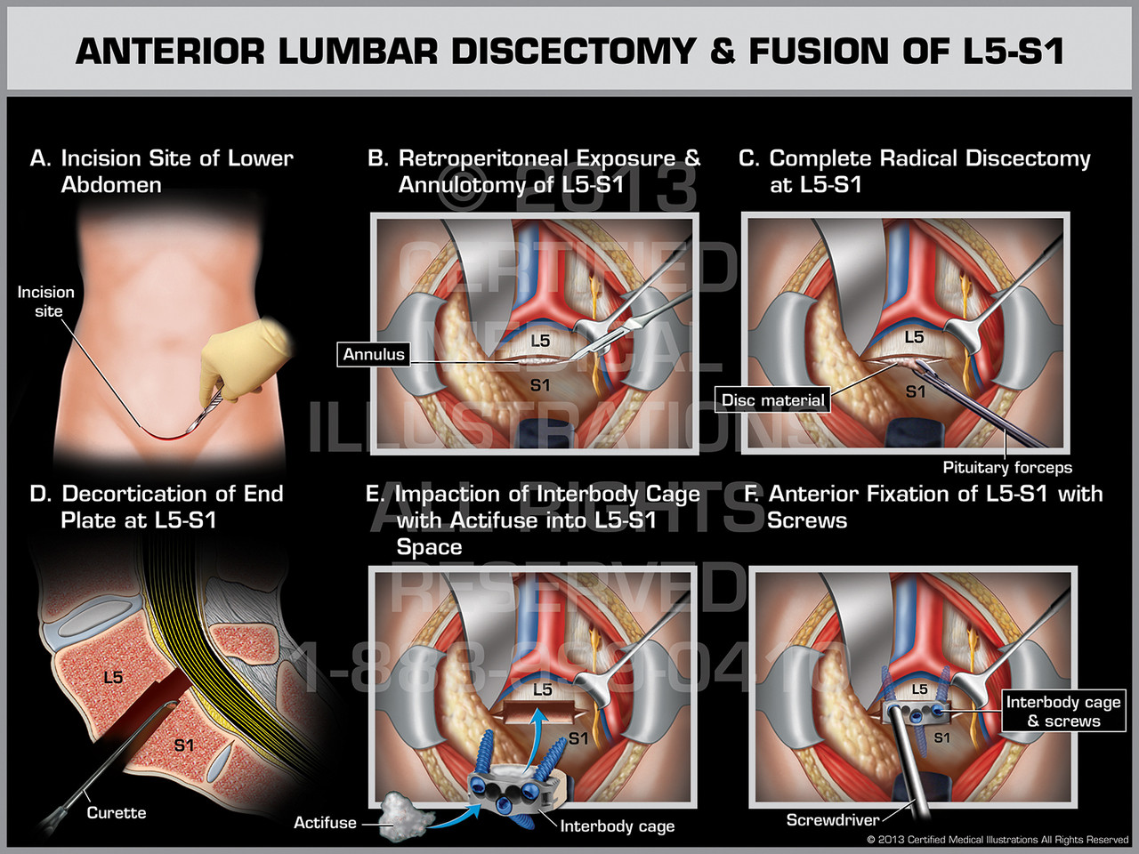 Anterior Lumbar Discectomy & Fusion of L5S1
