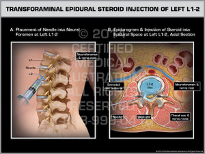 transforaminal steroid injection transforaminal steroid injection