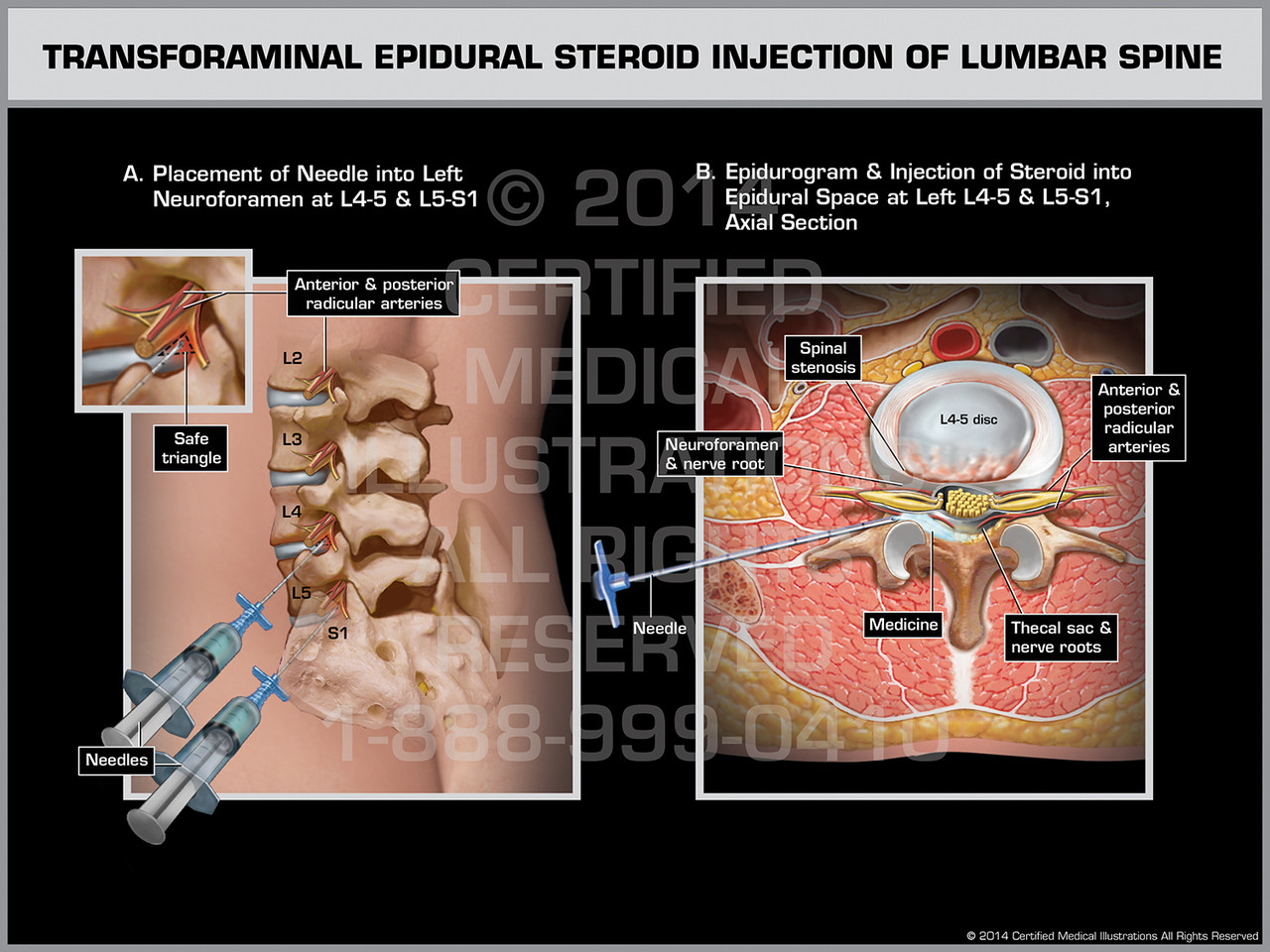 epidural steroid injection in spine