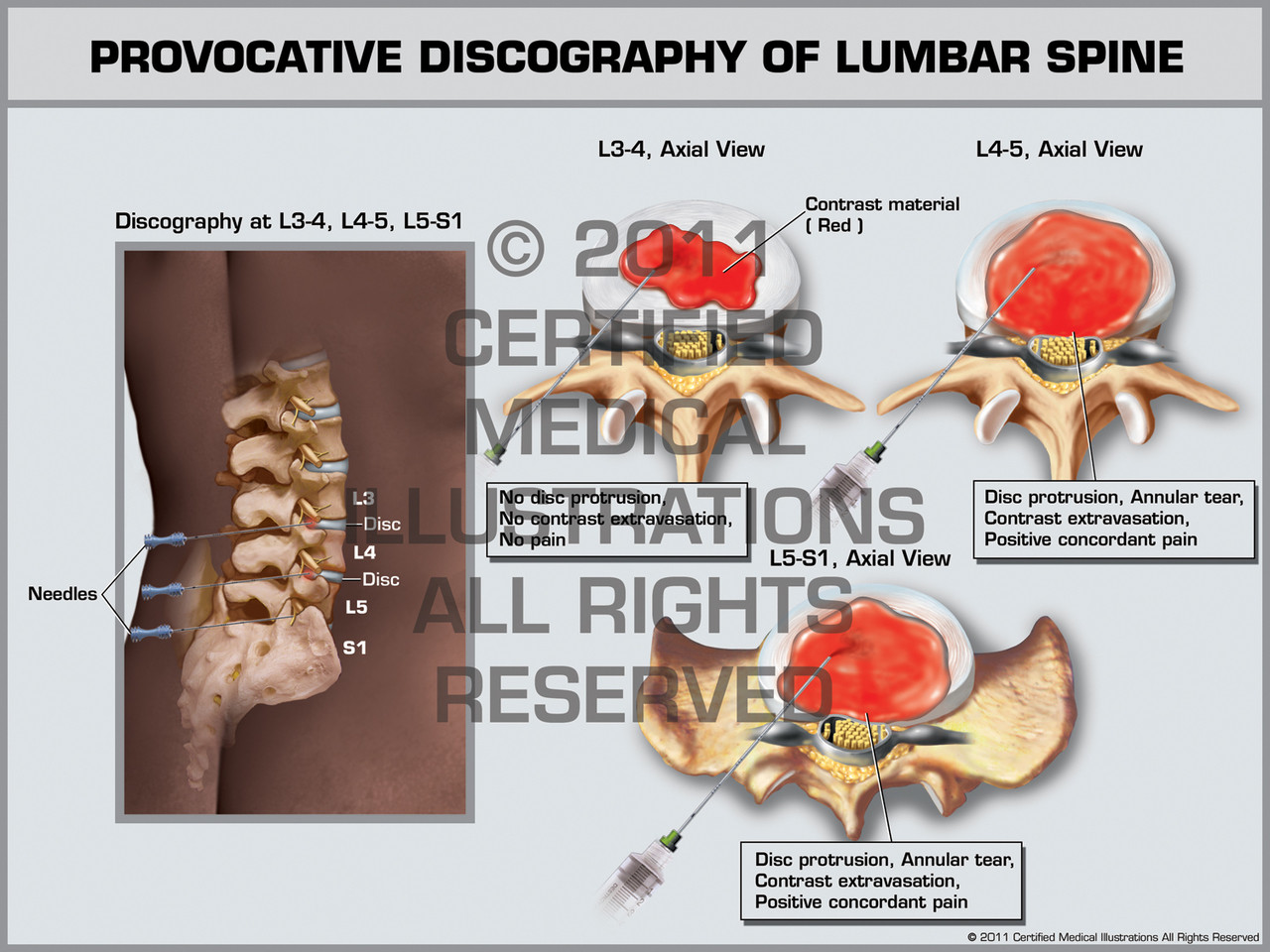 Discography Procedure