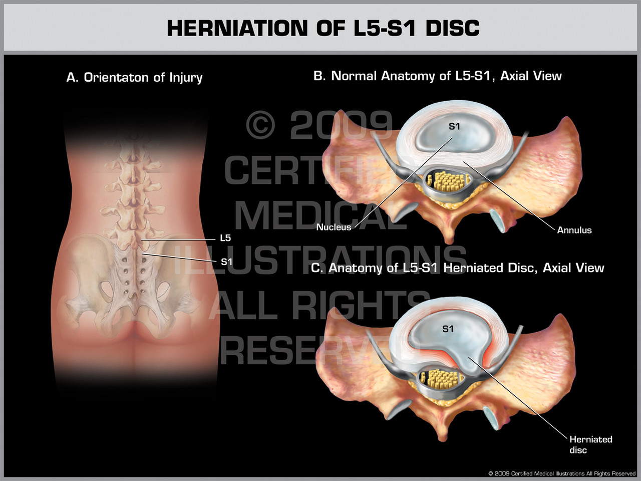 Herniated Disc L5 S1 How To Sleep With Herniated Disc L5 Symptoms