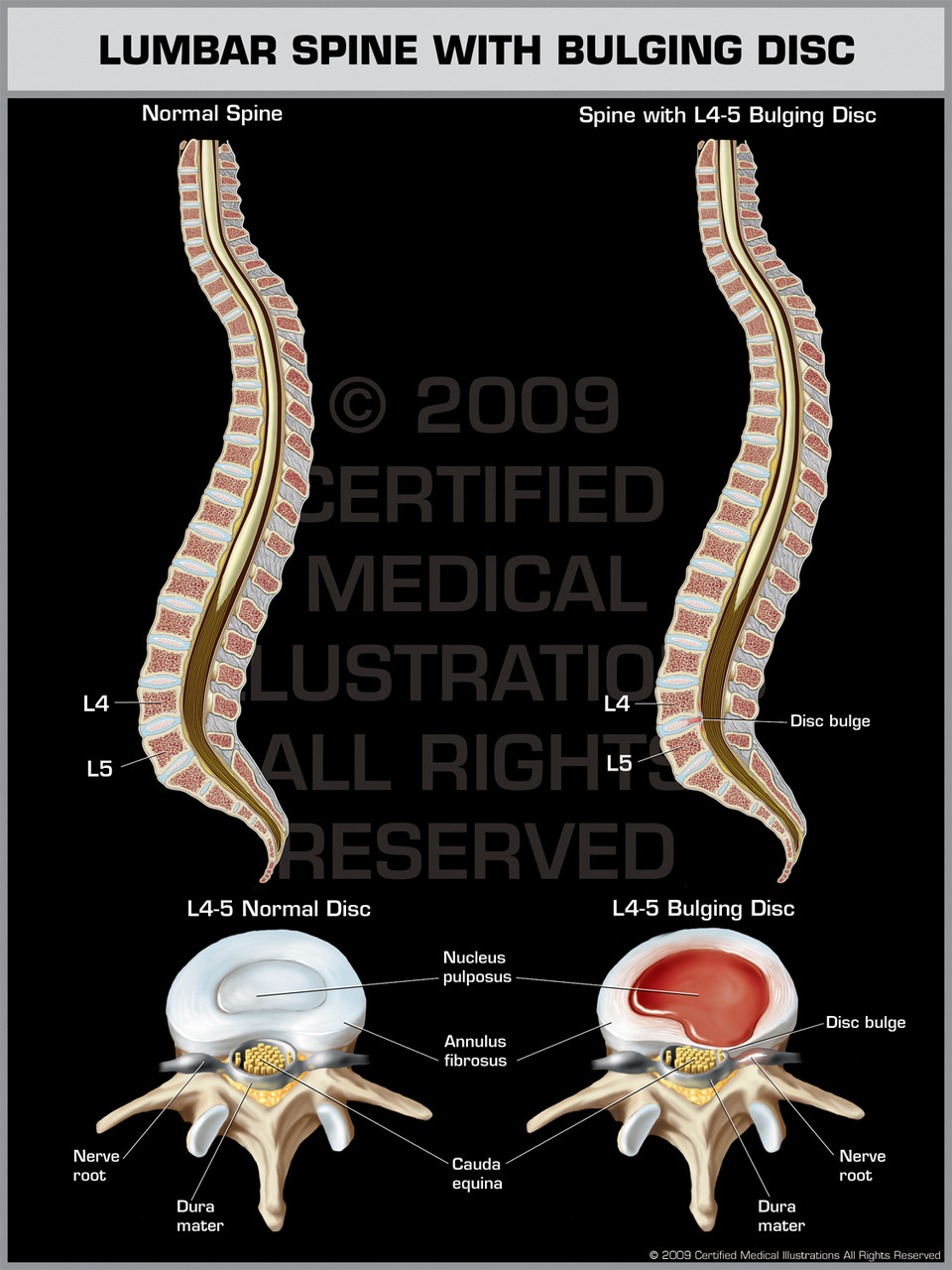 Lumbar Spine with Bulging Disc