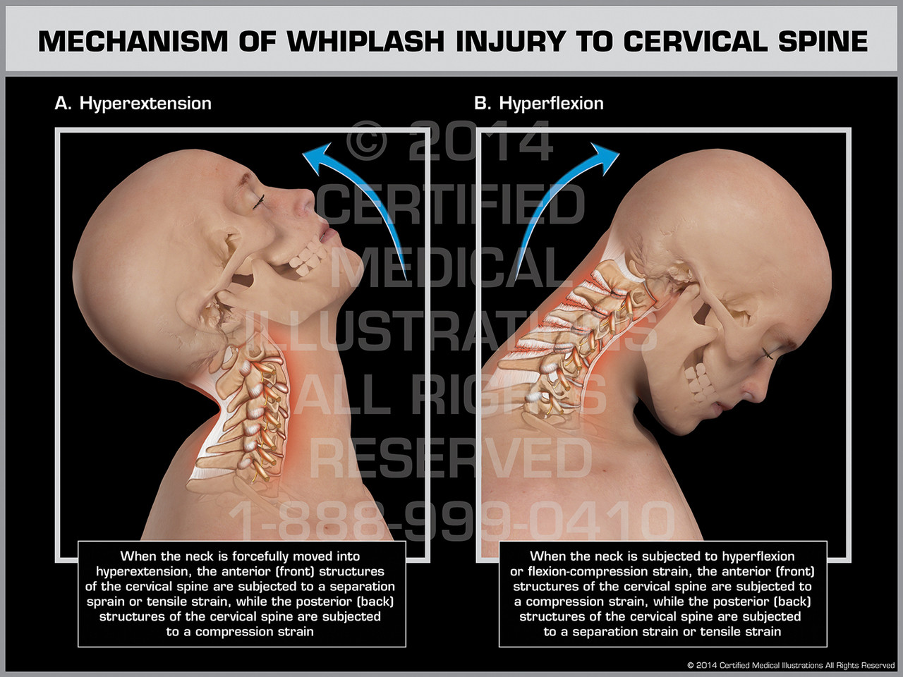 Mechanism of Whiplash Injury to Cervical Spine Male orthopedic pain diagram 