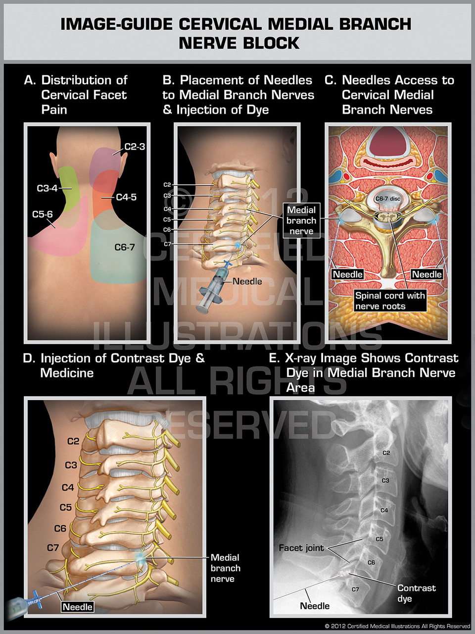 Image-Guide Cervical Medial Branch Nerve Block Male