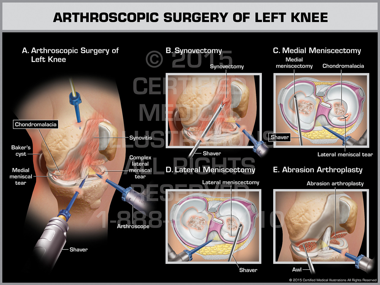 Arthroscopic Surgery of Left Knee