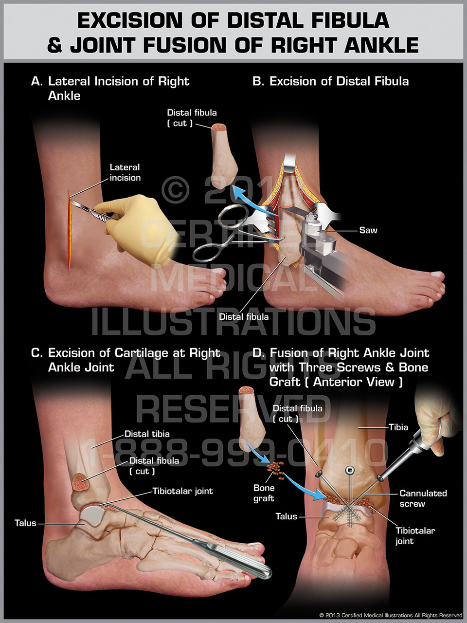 Excision of Distal Fibula & Joint Fusion of Right Ankle