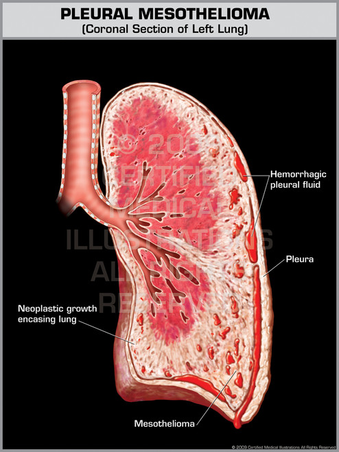 Pleural Mesothelioma