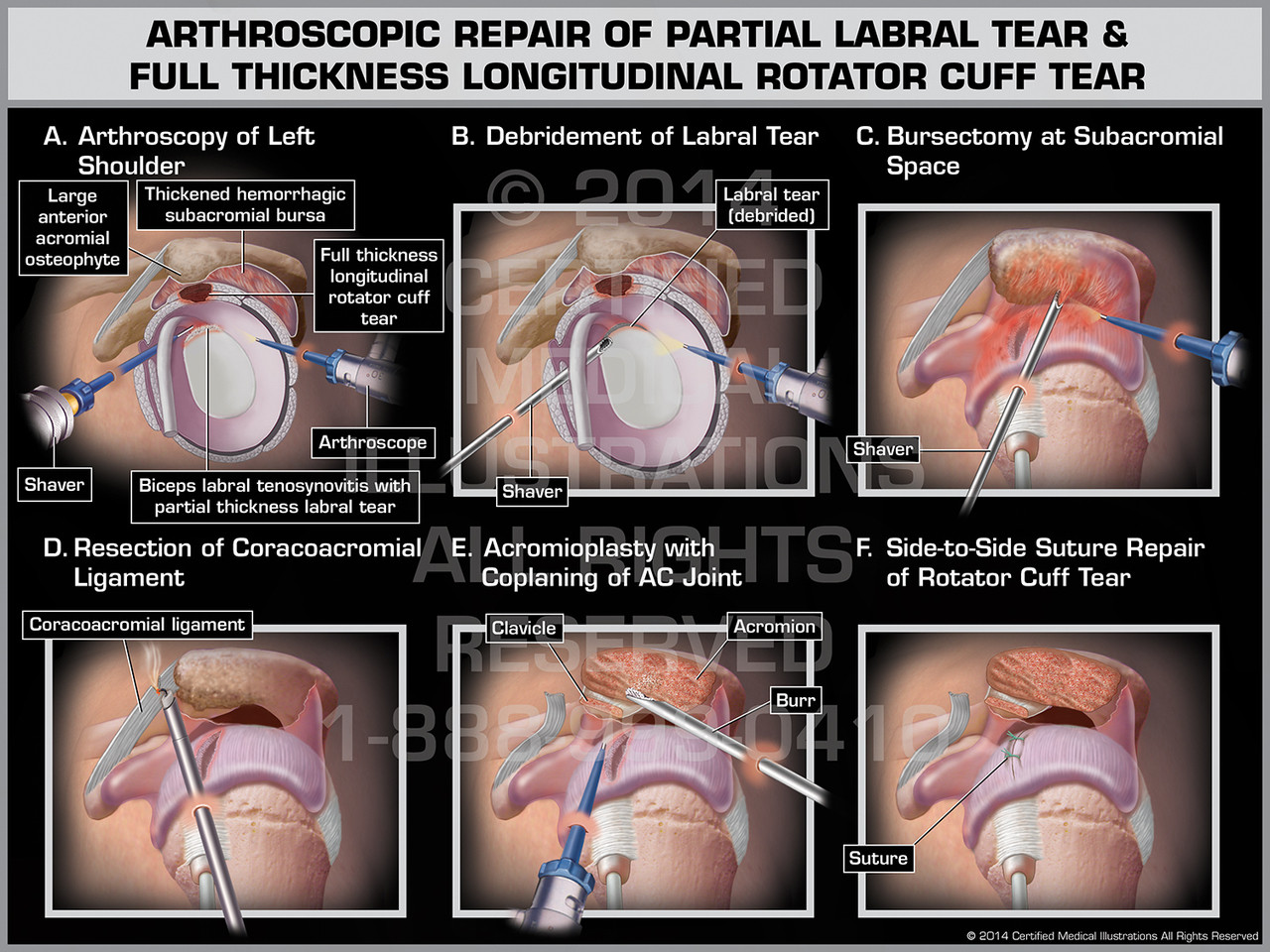 Partial tear rotator cuff surgery