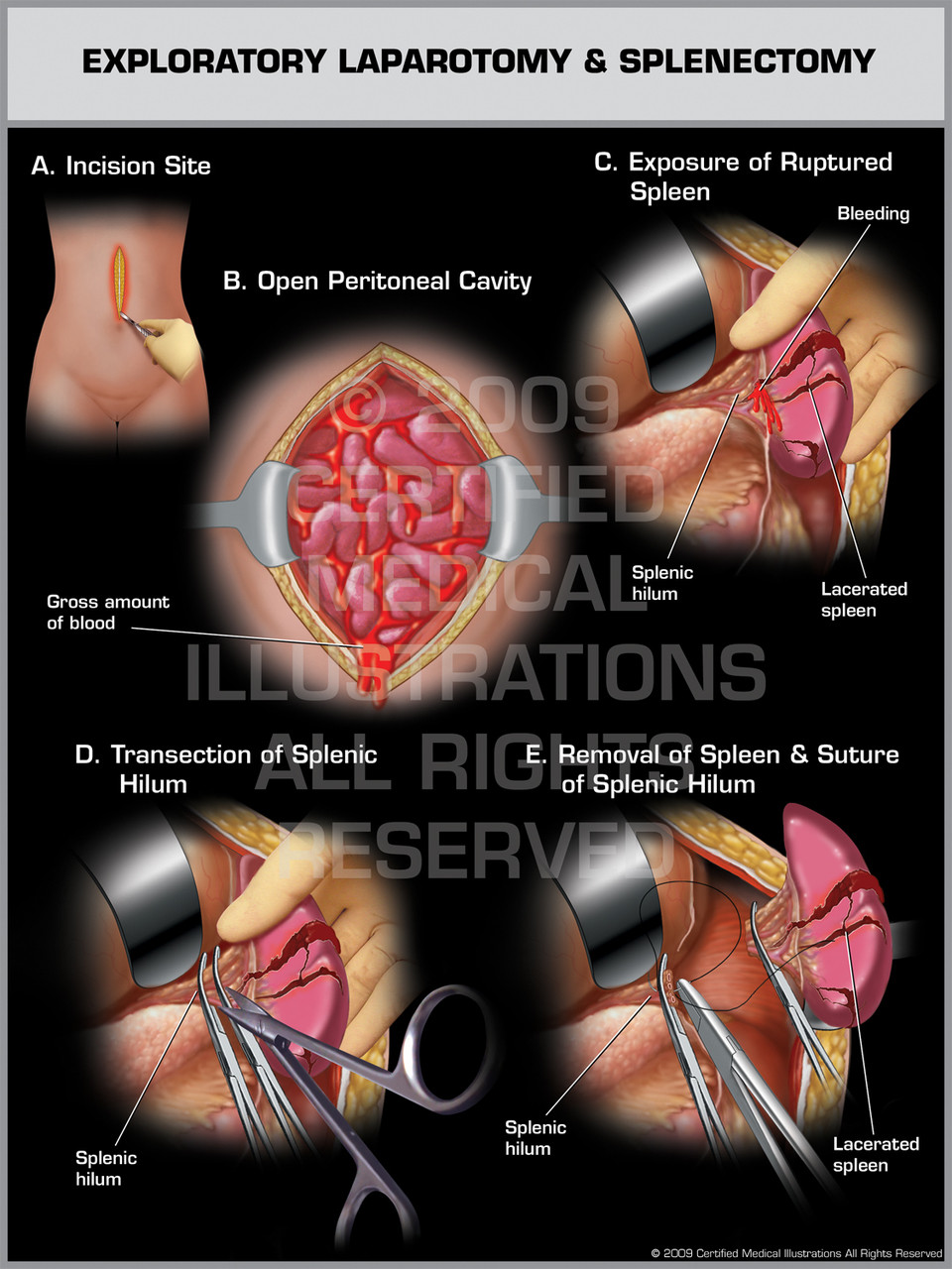 laparotomy exploratory splenectomy