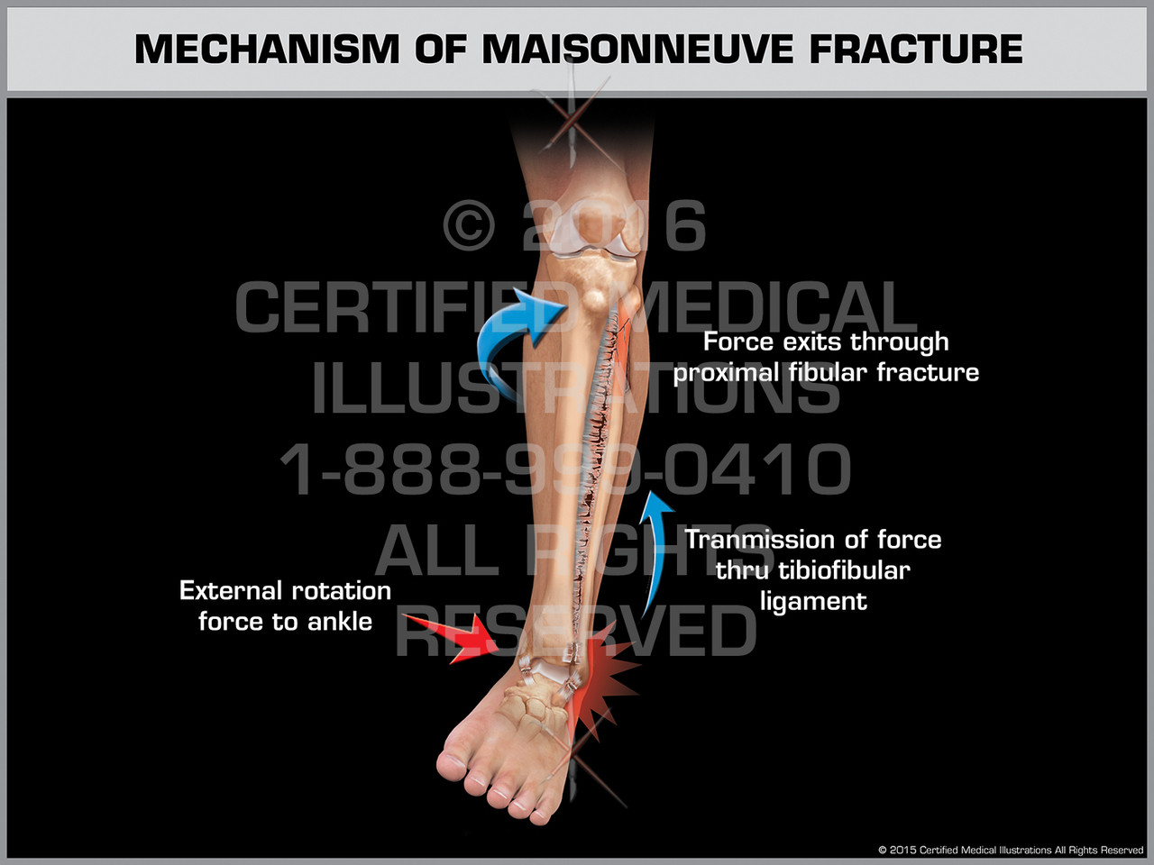 Mechanism Of Maisonneuve Fracture