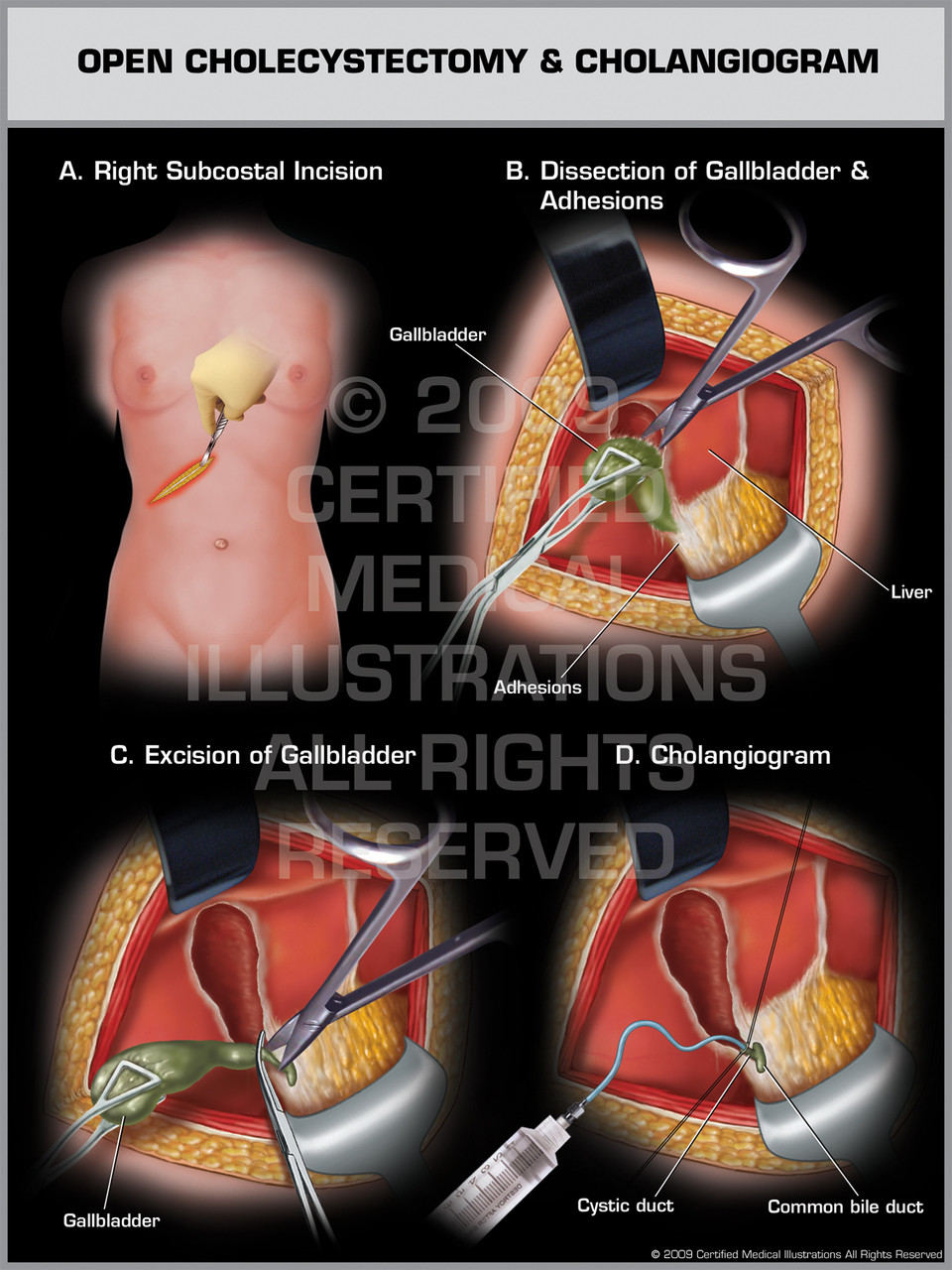 Open Cholecystectomy & Cholangiogram Open Cholecystectomy & Cholangiogram
