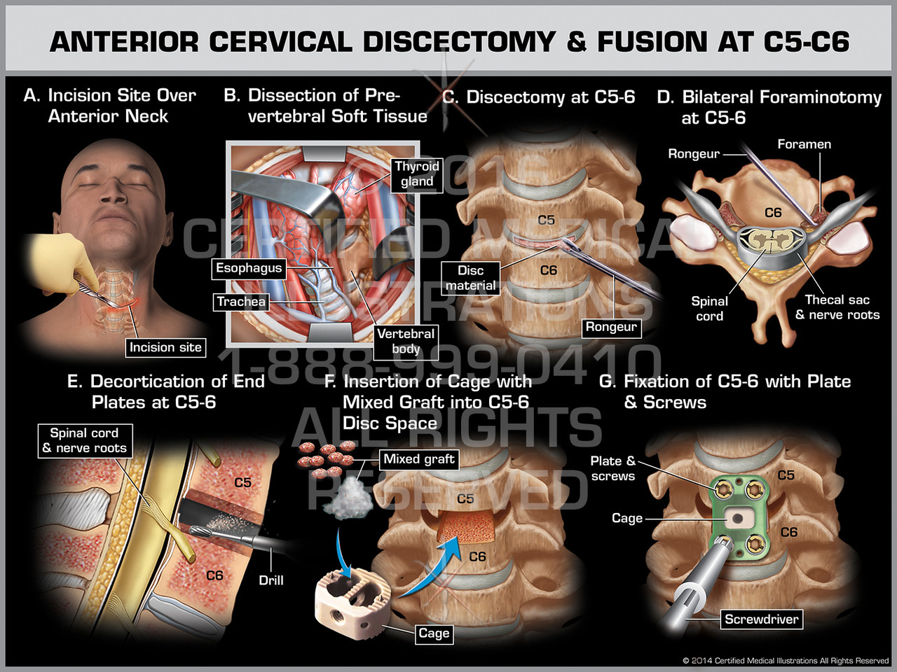 Anterior Cervical Discectomy & Fusion at C5-C6 - Print Quality Instant